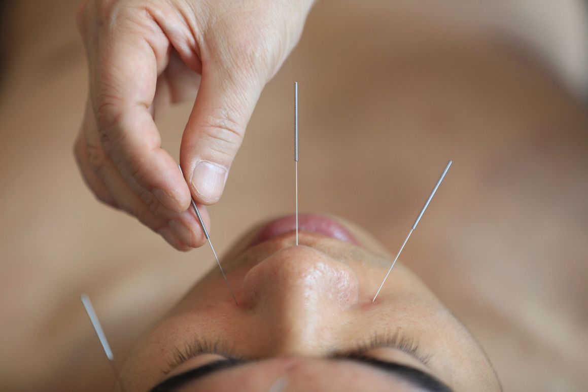 Acupuncture